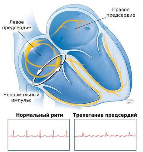 Как проявляются симптомы трепетания предсердий?