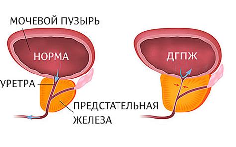 Кальцинаты предстательной железы у мужчин