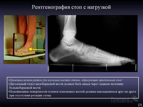 Когда и кому показано проведение рентген стопа с нагрузкой?