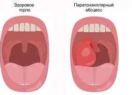 Когда следует обратиться к врачу при подозрении на абсцесс бартолиновой железы