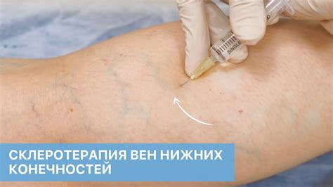 Компрессионная склеротерапия вен нижних конечностей