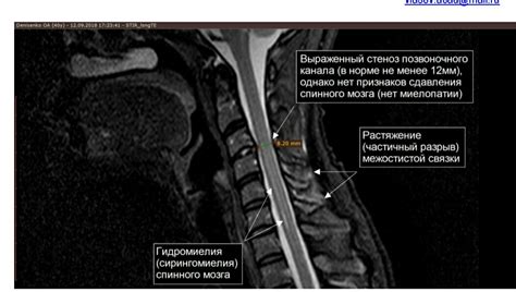 Компрессия спинного мозга