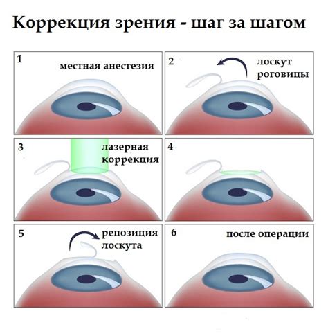 Коррекция зрения 0 25 у взрослых