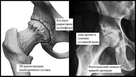 Костные наросты на суставах - причины и симптомы