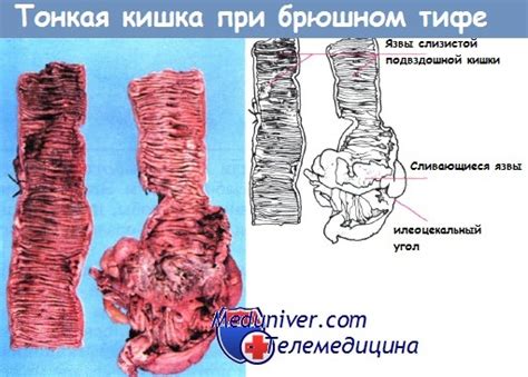 Кровотечение внутри живота при брюшном тифе