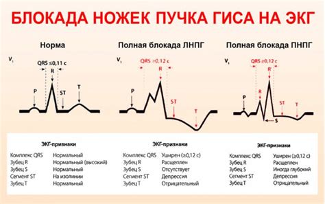 Лечение блокады передней ножки пучка гиса