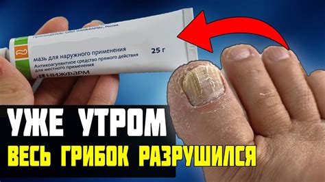 Лечение грибка на ногах с помощью народной медицины