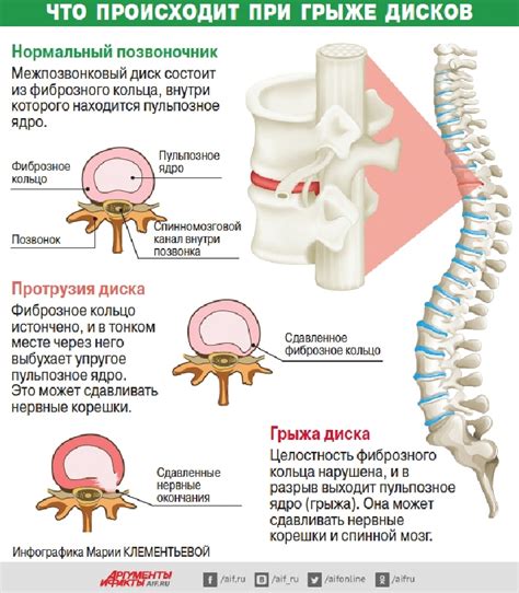 Лечение грыжи позвоночника и восстановление нормальной функции ноги