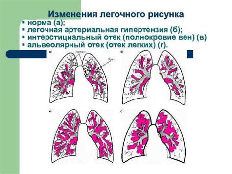 Лечение диффузной деформации легочного рисунка