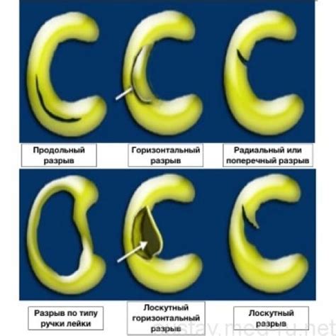 Лечение мениска 3а степени