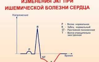 Лечение нарушений реполяризации в кардиологии