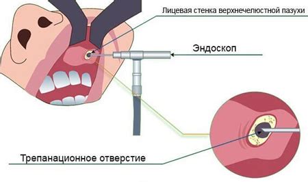 Лечение патологий верхней стенки пазухи