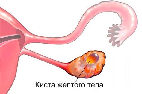 Лечение разрыва желтого тела яичника