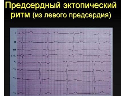 Лечение эктопического предсердного ритма у ребенка