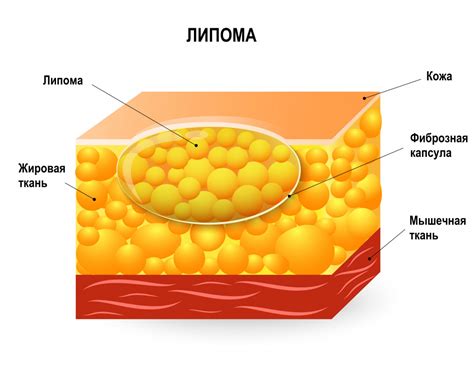 Липомы: жировые опухоли, вызывающие дискомфорт