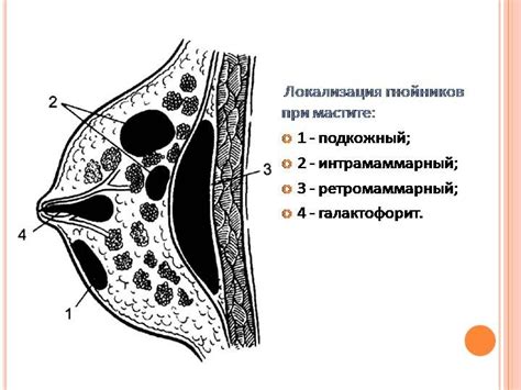 Мастит: воспаление молочной железы