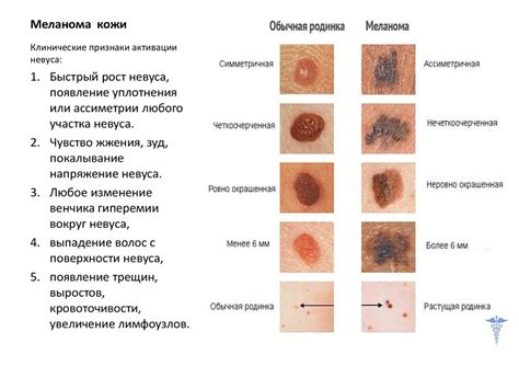 Меланома и другие виды рака кожи