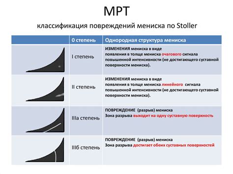 Мениска 3а степени по Stoller