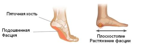 Меры для облегчения боли в ступне после работы