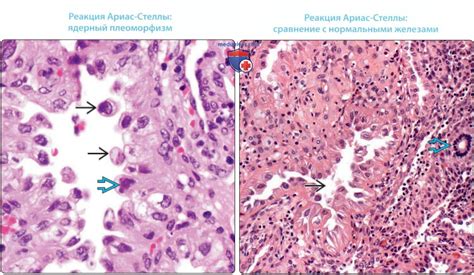 Методы диагностики ариас стеллы