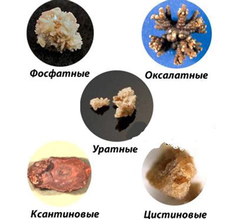 Методы диагностики движения камня в почках