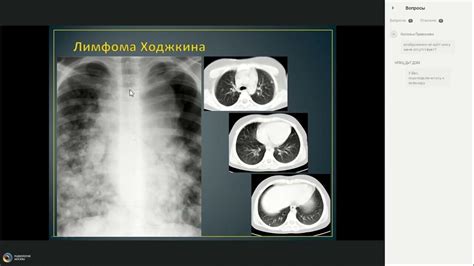 Методы диагностики очагового затемнения