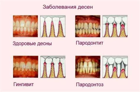 Методы лечения воспаления десен