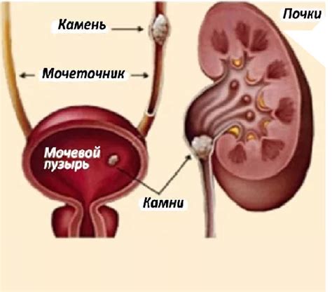 Методы лечения и профилактика солевых кристаллов в почках