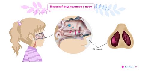 Методы лечения полипа в носу у ребенка