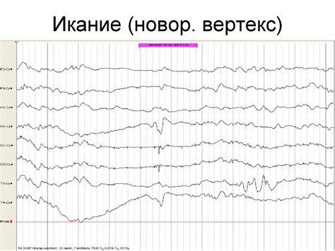 Методы устранения миографических артефактов на ЭЭГ