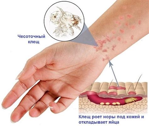 Механические причины чесотки в икре