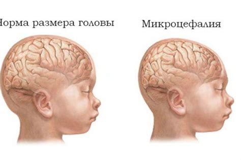 Микроцефалия: определение и проявления