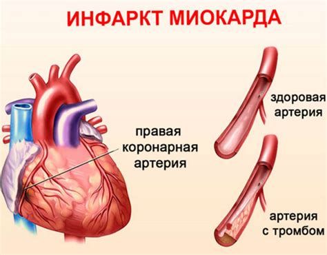 Миокард: причины, симптомы, лечение