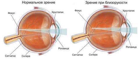 Миопия высокой степени: 7 факторов, негативно влияющих на зрение