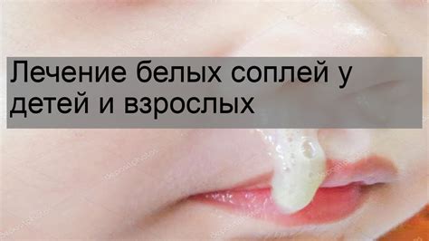 Народные методы лечения белых густых соплей у ребенка