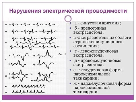 Нарушение внутрижелудочковой проводимости у ребенка