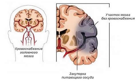 Нарушение кровообращения в мозге