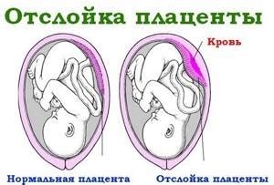 Нарушение маточно плацентарной гемодинамики: симптомы и признаки