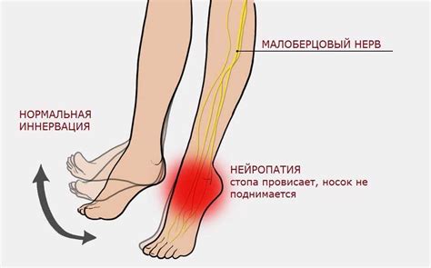 Нейропатия стоп: симптомы и методы лечения