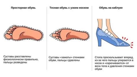 Неправильная обувь и ее влияние на жжение ног