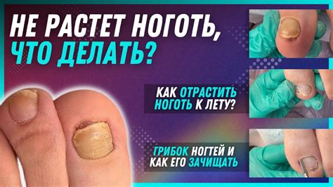 Ноготь растет со стороной: что делать?