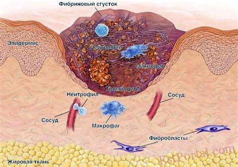 Образование рубца и рубцовой ткани