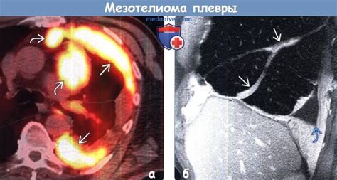 Обусловлено нарушениями целостности плевры