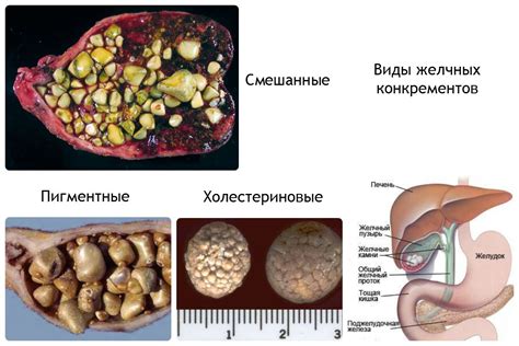 Общая информация о камнях в желчном пузыре