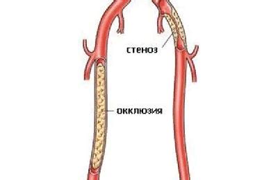 Окклюзия сосудов