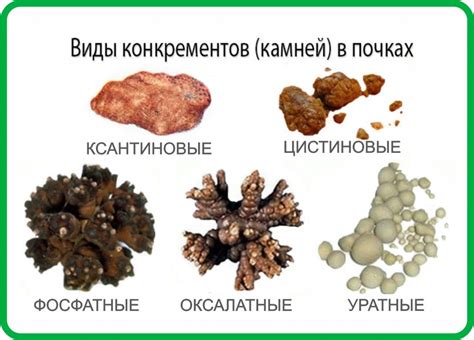 Оксалаты, камни и инфекции