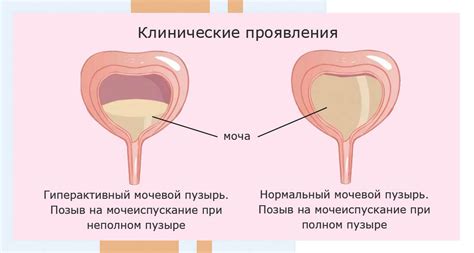 Опасности опущения мочевого пузыря у женщин