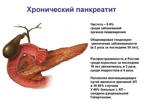 Описание Хронического панкреатита (ХПБ)