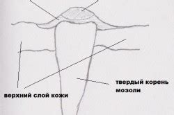 Определение и причины вывиха косточки на мизинце