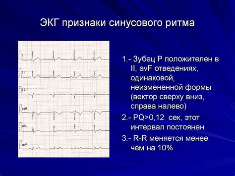 Определение основного ритма синусового на холтере